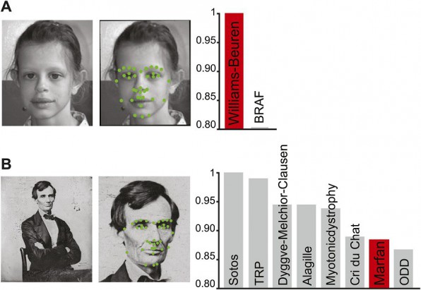 Un exemple du fonctionnement du logiciel. Le syndrome est  gauche repr suite  l'analyse de la photo.