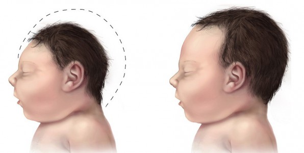 Schma comparatif d'un nouveau-n atteint de microcphalie et d'un bb avec une formation crnienne classique.