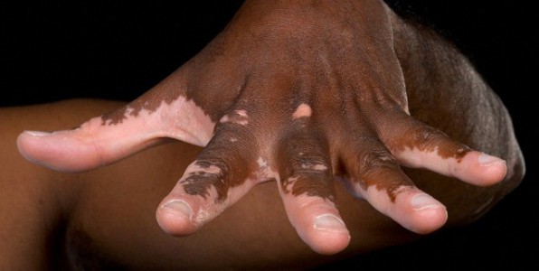 dpigmentation de la peau due au Vitiligo